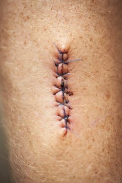 idaho falls doctor laceration repair